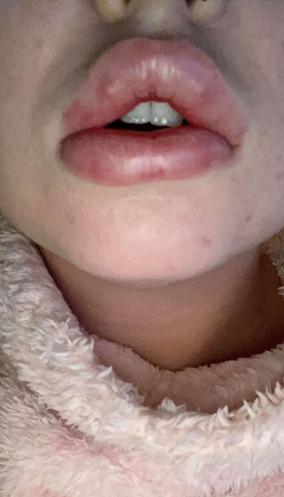 医生|女子做丰唇嘴肿得像香肠，消肿后医生免费又做一次结果肿得更严重