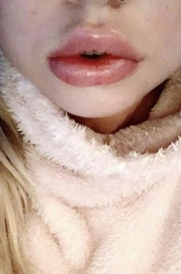 医生|女子做丰唇嘴肿得像香肠，消肿后医生免费又做一次结果肿得更严重