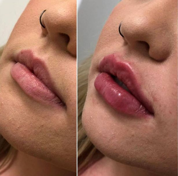 医生|女子做丰唇嘴肿得像香肠，消肿后医生免费又做一次结果肿得更严重