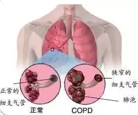 慢性阻塞性肺疾病|对于60％早期无症状的慢阻肺患者，体检中有一项检查至关重要！