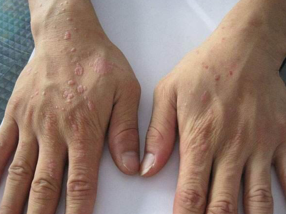 【手背长"瘊子",抠了还长!可能是hpv感染在"作祟"】