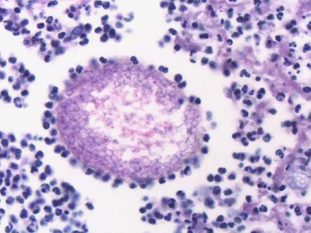 山谷热|美国山谷热频发已致中国公民3病2死，中驻美使馆发紧急提醒！