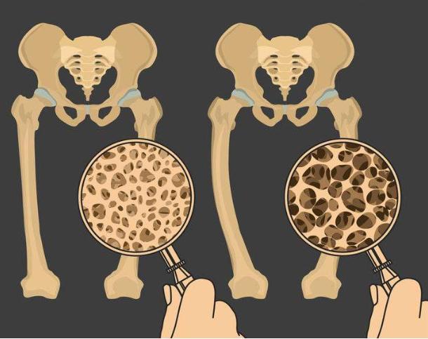 类风湿性关节炎|起床后手指僵硬、合不拢，别忽视，可能与这3种疾病有关