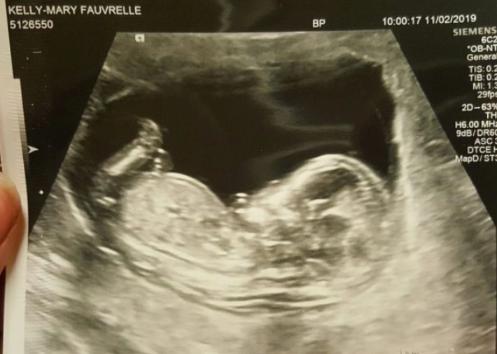 阿伦·麦肯齐|孕妇凌晨被前男友连捅21刀死亡，医生直接在凶案现场对其剖腹产