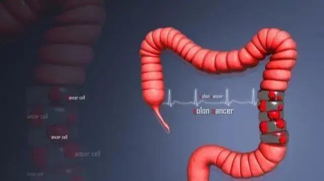肠癌多是 拖 出来的 出现4种症状 十有八九肠道 病 得不轻 腾讯新闻