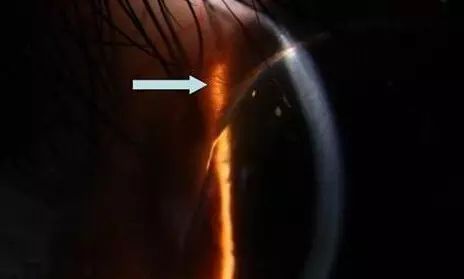 近视手术|北京首大眼科马玲珍：做近视手术需不需要住院？