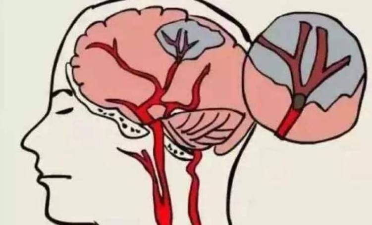 脑梗塞|脑梗的“祸根”找到了，专家提醒：若头部反复出现这3个情况，尽早去医院！