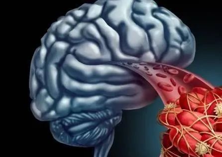 脑梗塞|脑梗的“祸根”找到了，专家提醒：若头部反复出现这3个情况，尽早去医院！