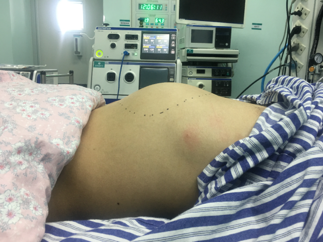 24岁男子小徐(化名)肚子鼓起来西瓜大,好似身怀六甲