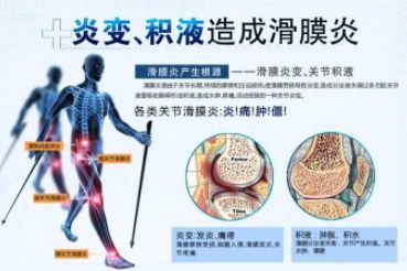 滑膜炎|滑膜炎疼痛真是太折磨人啦！爬山回来后就开始疼痛……