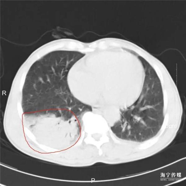 肺部感染|海宁大伯突然发热、咳嗽、高烧40℃不退，肺部感染…竟是因亲密接触…