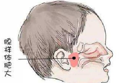 腺样体肥大|潍坊耳鼻喉医院：儿童腺样体肥大是否采取手术很纠结？