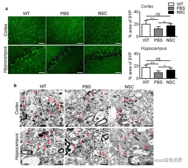 神经干细胞移植|人类神经干细胞移植可改善AD认知缺陷