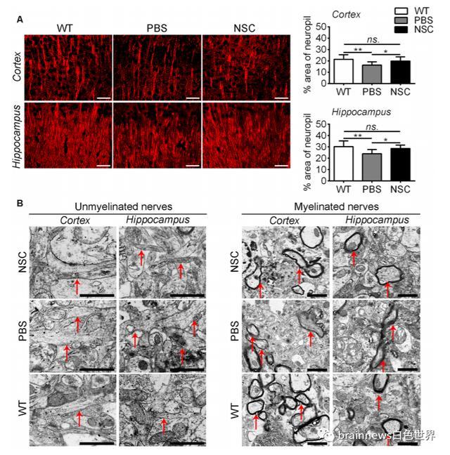 神经干细胞移植|人类神经干细胞移植可改善AD认知缺陷