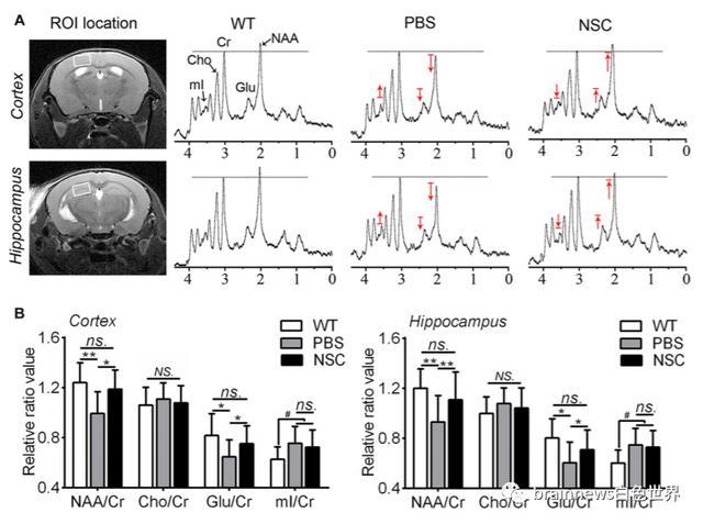 神经干细胞移植|人类神经干细胞移植可改善AD认知缺陷