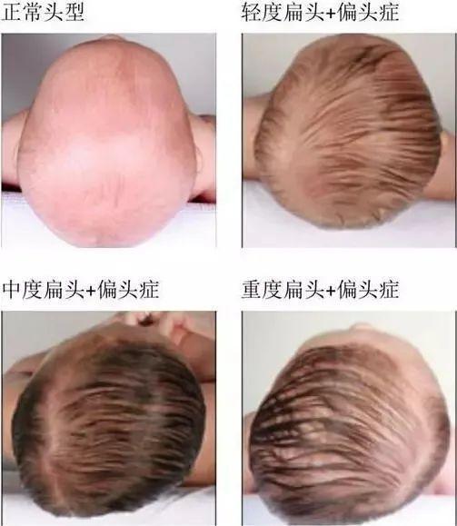 如果局部受到外力挤压,会导致头骨发育不对称,也就是出现"扁头综合征"