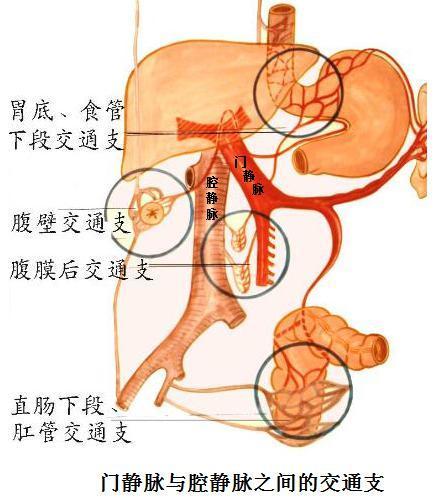 而建立侧支循环,其主要侧支循环有:(1)食道下段与胃底静脉的交通