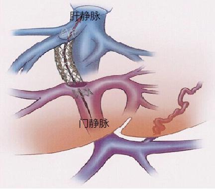 疗法是在食管下端曲张静脉内或静脉旁边注射硬化剂,使曲张静脉闭塞