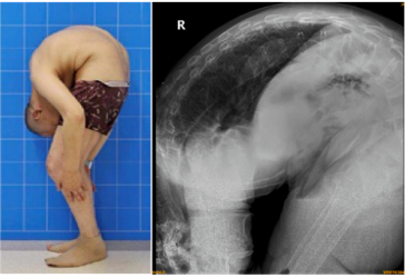风华正茂时因为患上最严重的强直性脊柱炎,成了「3-on折叠人」,不能直