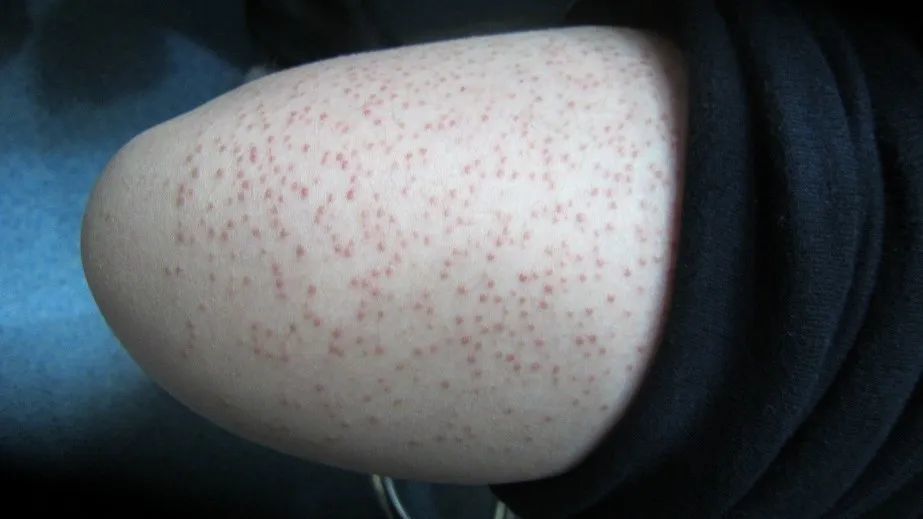 得了湿疹注意这4点好得更快!