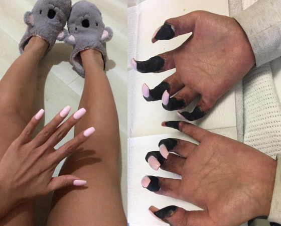 截肢|女子昏迷7天后发现手脚全发黑 无奈截肢保命