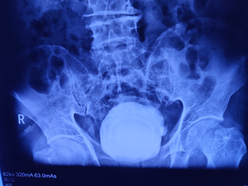 罕见74岁老人体内取出一斤重的膀胱结石