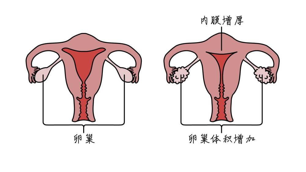 身体出现5个症状是多囊卵巢综合征的信号,重至不孕不育_腾讯新闻