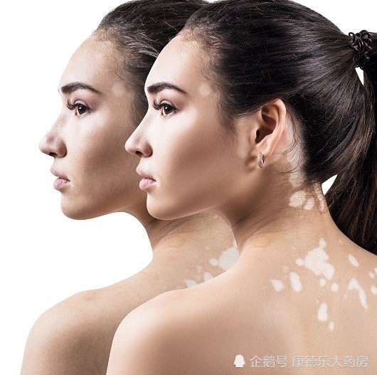 白癜风|白癜风治疗路漫长，夏季这些护理需要做好