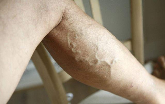 高血脂|血脂升高腿先知，腿部出现4个“症状”，是在说一件事：血脂高了