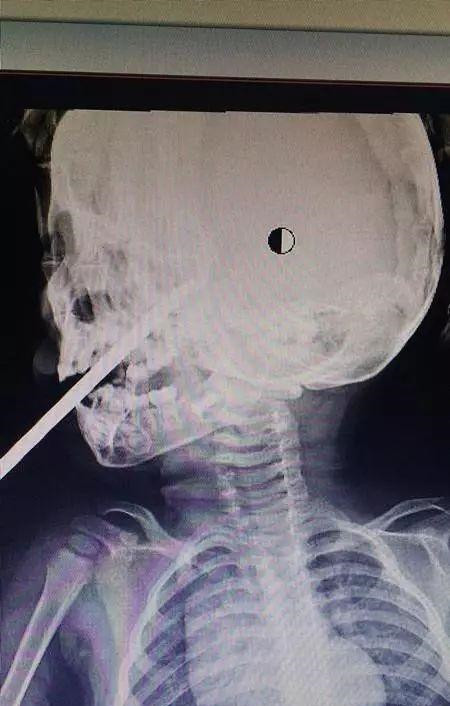 10岁女孩游乐场里玩耍,脑干被竹签刺穿!只因手里拿的串烤热狗