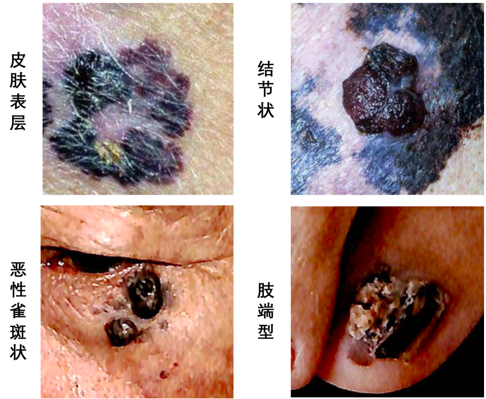 痣出现这些症状需格外警惕4招教你识别黑色素瘤