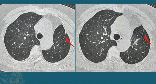 肺腺癌图片全景图图片