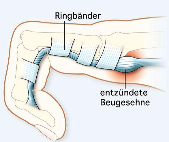 如果您正处于更年期正遭受手指肌腱炎腱鞘炎的困扰请看此文
