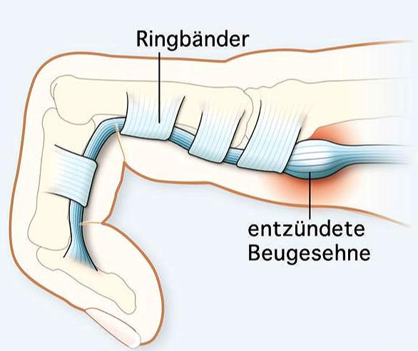 屈指肌腱腱鞘炎图片