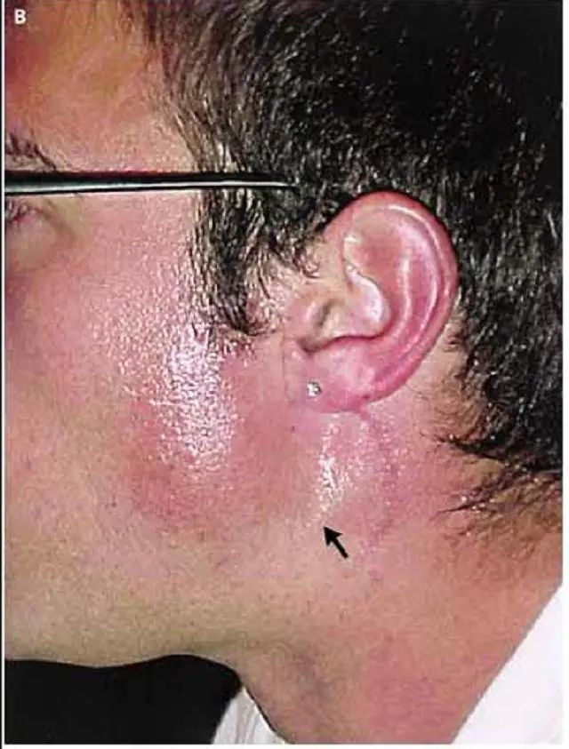 汗腺|为什么有些人吃饭时头部特别能出汗？