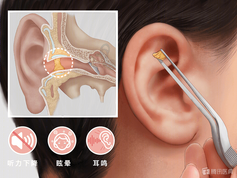 耳屎到底要不要掏 医生这个答案可能让你有点意外 腾讯新闻