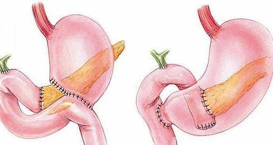 为什么胰腺癌被称为万癌之王医生5诱因愿你一个都没中