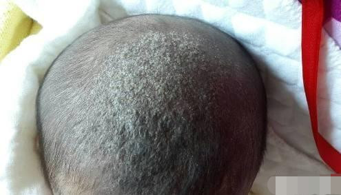 什么原因会导致新生儿的头上有污垢?