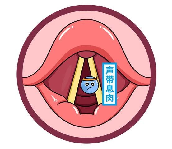 声带息肉也会被鼻炎抢风头就算做出点成绩状态好的时候能让人头疼只能