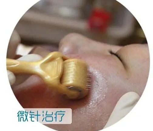 微针疗法是什么有什么作用
