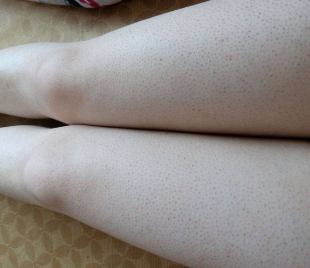 关于怎么样才能把鸡皮肤给弄掉的信息