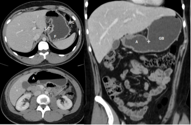 一文读懂急性胃痛ct检查表现