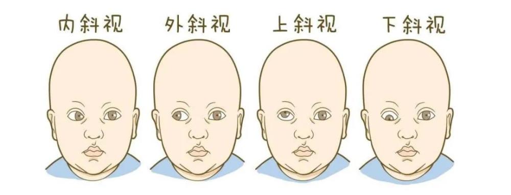 5岁女娃天天上演"歪头杀",家长觉得可爱,医生却说这其实是一种病