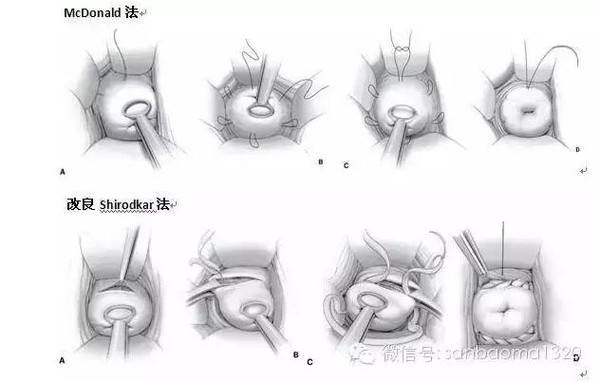 3年流产3胎,这次她终于成功顺产!