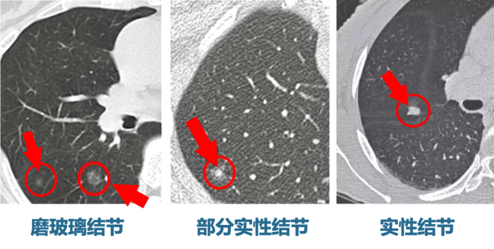 核保案例分享:磨玻璃肺结节7mm,重疾险除外承保_腾讯新闻