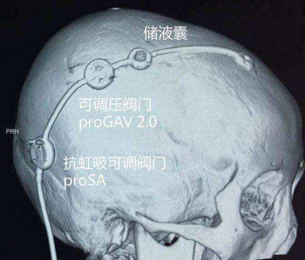 絕大多數的情況下都是採取外科手術的治療為主,腦室外穿刺引流手術