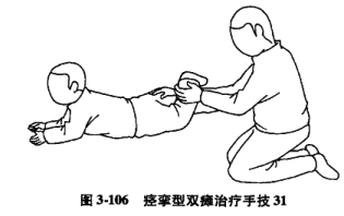 痉挛型双瘫运动疗法小儿脑瘫增强肌力训练