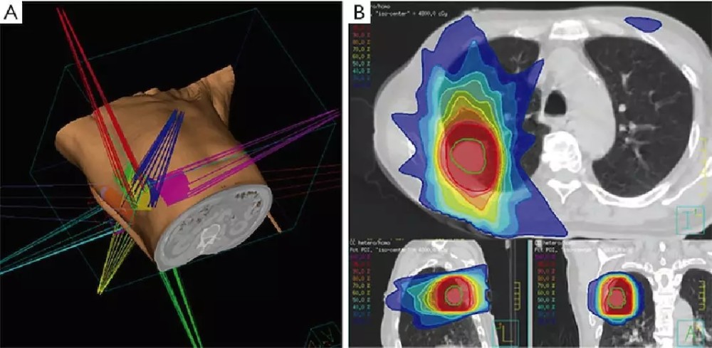 立體定向放療,你該瞭解什麼?這種治療方法提升患者5年生存率!