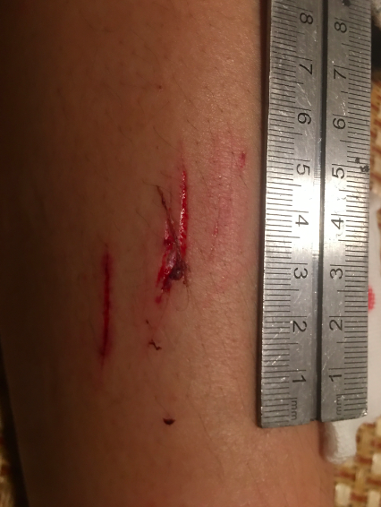 房山一精装房浴室玻璃门炸裂 19岁女孩浑身20多处多处被扎伤