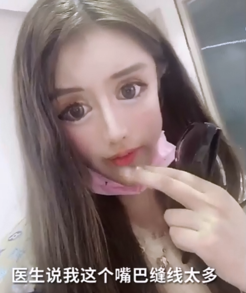 整容|13岁就开始整容的女网红出现后遗症！医生称嘴巴缝太多无法修复